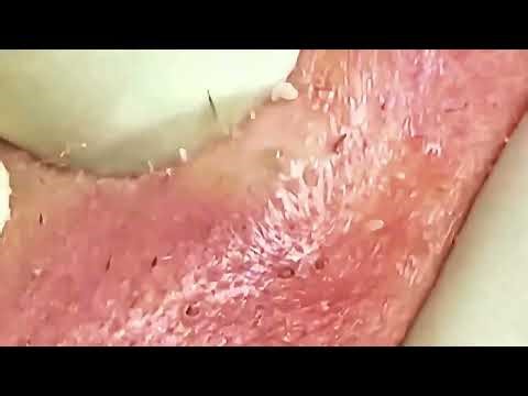 pimple popper blackhead ,blackhead removal satisfying #akne ^#extraction #sivilce #skincare 566