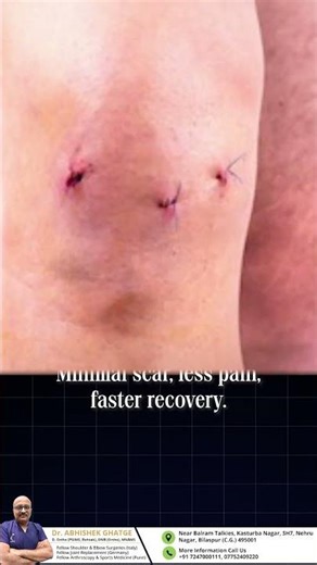 🔹 Keyhole Surgery Explained: Faster Recovery with Arthroscopy | Less Pain, More Relief