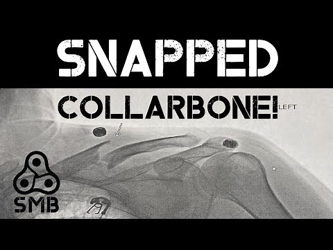 Broken Collarbone | MTB Accident | How Long to Recovery?