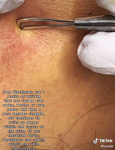 This is one of the many reasons to get you skin deeply cleansed by a professional. Open comedones usually go away on their own but sometimes they go and need to be extracted. #pimplepopperaddict #extractions #poppin #noworrieshere #facial #holisticesthetician #pimplepopper #glovesareagoodidea ##losangeles #glendale #glendalecalifornia #losfeliz #esthetician #estheticiantiktok #atwatervillage #lovewhatyoudo #hit1000fans
