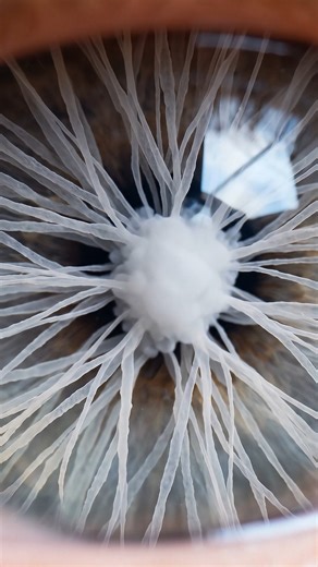 Cataract formation happens when the normally clear lens inside the eye slowly becomes cloudy. The lens is made of tightly arranged proteins that stay transparent so light can pass through easily. Over time these proteins can begin to clump together which creates soft cloudy areas inside the lens. This cloudiness starts small and usually does not affect vision at first but it gradually spreads as more proteins stick together. As the clouding grows the lens loses its clarity and light can no longe