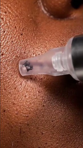 “Cinematic Vacuum Blackhead Removal – Real Pores in Ultra 4K Macro