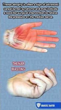 What Is Thenar Atrophy ? - UTOLEDO Orthopaedics