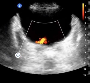 2.2K views · 92 reactions | Power Doppler is here! Remember this mode for increased sensitivity to low flow, such as ureteric jets. Update your app to 1.13 to try Power Doppler across six #ButterflyiQ presets, including Abdomen, Abdomen Deep, and Bladder. | Butterfly Network, Inc | Facebook