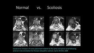 Anterior Vertebral Body Tethering for Scoliosis Correction