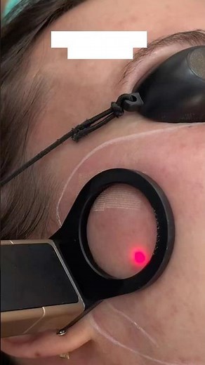 CO2 Laser for Acne Scars: What Really happens during Treatment (Fully Explained)