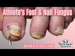 Reverse Nail Fungus Caused by Athlete's Feet