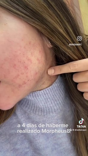 Morpheus 8 Treatment: Before and After Results