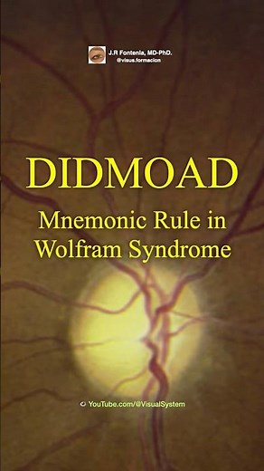 Wolfram Syndrome. DIDMOAD, Mnemonic Rule.
