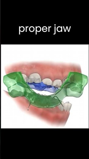 Correcting Class II div 1 malocclusion with Twin Block #braces #teeth #dentist #treatment