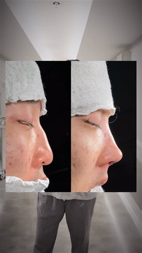 Dra. Julia Jorge - Plástica Facial em São Paulo on Instagram: "Rinoplastia em nariz asiático não pode ser generalizada. Cada nariz tem características únicas e merece uma avaliação individualizada. O objetivo é valorizar a identidade do paciente, respeitando sua anatomia e buscando harmonia e função. Rhinoplasty in Asian noses should not be generalized. Each nose has unique characteristics and deserves an individualized evaluation. The goal is to enhance the patient’s identity, respecting their 