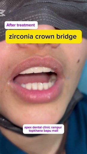 zirconia teeth || #shortsfeed #viral #shorts #dental #dentist # #teethwhitening smiledesigndental