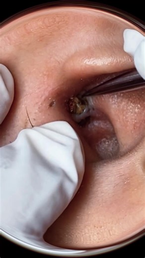 Akne im Ohr #akne #mitesser #aknederm #aknetedavisi #pickel #fürdich