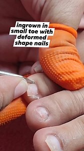 ingrown in small toe & deformed nail shape need to repair #ingrowntoenail #ingrownnail #ingrowntoenailremoval #howtoremoveingrown # | Cynthia M. Lintag
