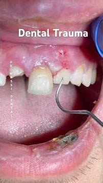 Dental Trauma accident