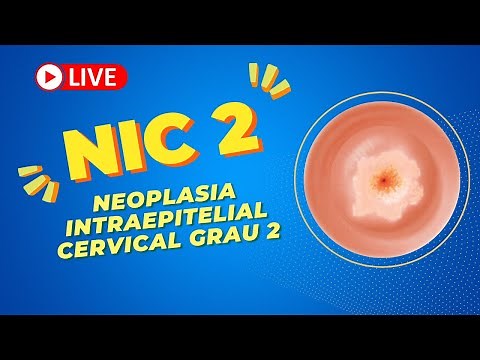 Nic 2: neoplasia intraepitelial cervical grau 2 = neoplasia do Colo do útero