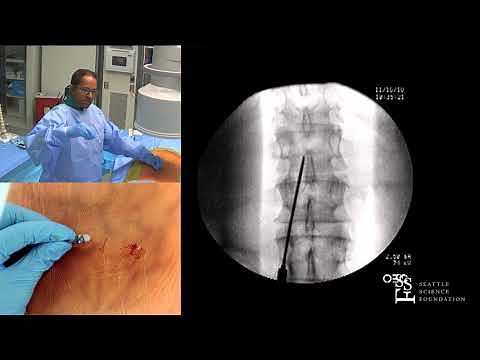 Lumbar Spinal Cord Stimulation Trial - Ramana Naidu, MD