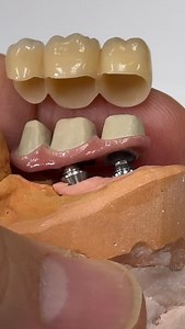 13K views · 71 reactions | For Multi unit implants! | CEO Luke Kahng | Facebook