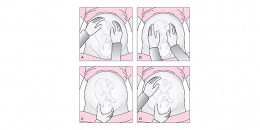 Leopold’s Maneuver - RNpedia