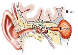 Acoustic Neuroma (aka acoustic schwannoma, vestibular schwannoma) »  Lillian S. Wells Department of Neurosurgery at the University of Florida » College of Medicine » University of Florida
