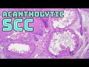 Acantholytic SCC Follicular Squamous Cell Carcinoma under Microscope pathology histology skin cancer