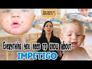 Everything you need to know about impetigo!