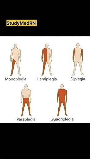 types of paralysis