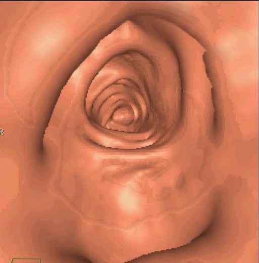 CT/TC Multislice virtual colonoscopy - Colonoscopia Virtual