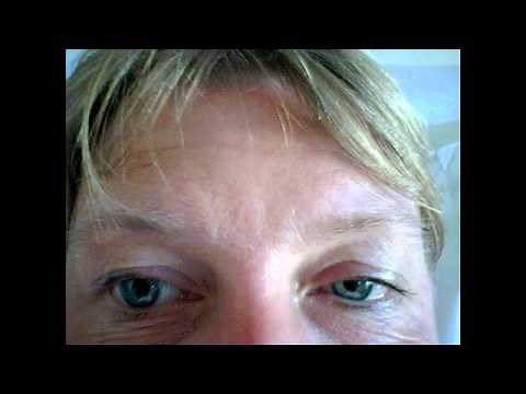 Horner's Syndrome - Causes, Symptoms & Mnemonics