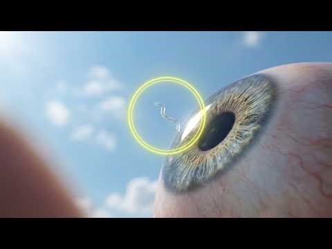 Everything Your Doctor Didn't Tell You About Eye Floaters (Full Guide)
