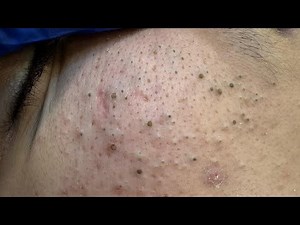 [ASMR] Acne Treatment and Blackhead Removal Facial Care