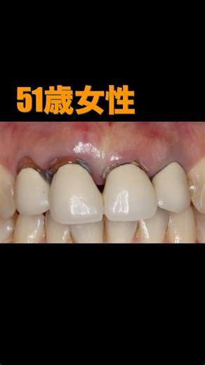 Introducing a case where a front tooth was implanted #implant #dentist #front tooth