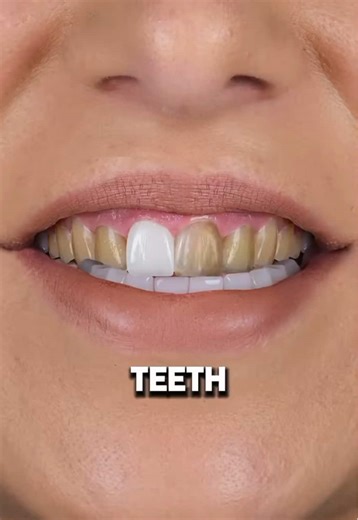 Safe Teeth Whitening Tips from a Professional Dentist
