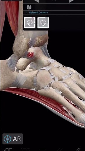 Ankle Sprain Animation