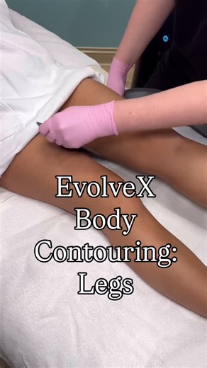 EvolveX Body Spotlight: Legs ✨🦵 We’re highlighting one of the many areas you can treat with EvolveX Body Countouring — the legs. A common concern we hear? Crepey skin around the knees, lack of definition in the legs, and areas that just won’t firm up no matter how many squats you do. EvolveX is a painless, non-invasive body sculpting treatment that targets both muscle and skin. For the legs, EvolveX uses advanced electrical muscle stimulation to activate and build muscle in the thighs while rad