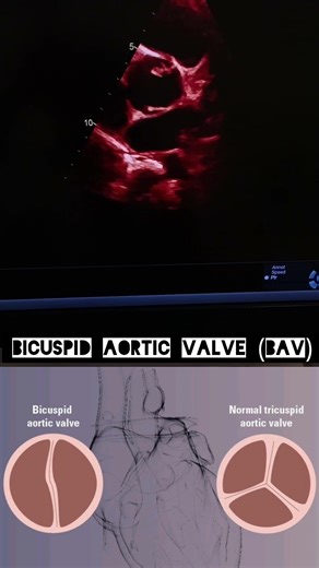 BAV is a common congenital heart defect where the aortic valve has two leaflets instead of three.🫀
