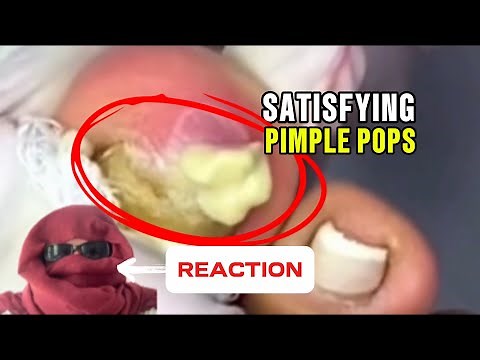 10 Minutes of Deep Pimple Popping & Blackhead Removal (Ultimate Compilation)