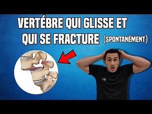 TRAITEMENT DU SPONDYLOLISTHÉSIS LOMBAIRE : EXERCICE KINÉ