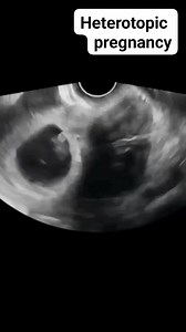Heterotopic pregnancy on ultrasound #viralreelsシ #viralvideoシ #educationalreels #baby #radiology #pregnancy #ultrasound #ectopicpregnancy | Radiology Interesting