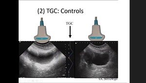 Ultrasound Guidance for MIP & PCNL