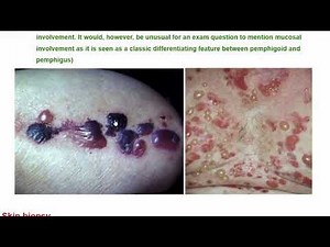 What is Bullous Pemphigoid? Causes, Symptoms & Treatment