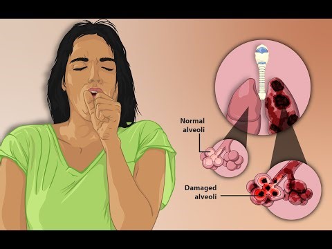 Chronic Smoking, Lymphatic System of the Lungs & Emphysema by Laura Santambrogio, MD, PhD