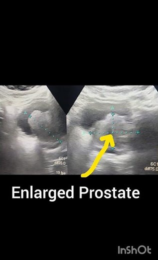 Ultrasound prostate showing BPH! Ultrasound KUB showing enlarged prostate#ultrasoundmadeeasy86#viral