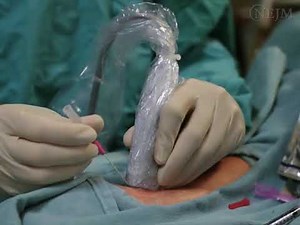 Inserción guiada por ecografía de un catéter arterial radial _ VIDEOS IN CLINICAL MEDICINE_ NEJM