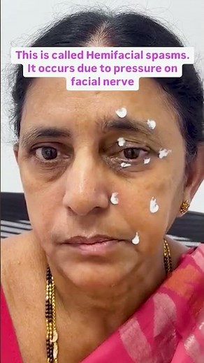 Say Goodbye to Embarrassing Facial Twitching | Dr Anamika Joshi | #HemifacialSpasms #FacialTwitching