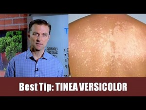 Tinea Versicolor Natural Remedies: Relief Tips | Dr. Berg