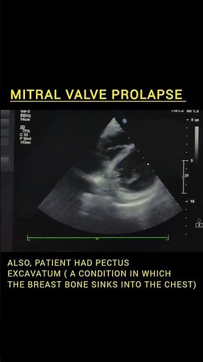 Mitral Valve Prolapse | #echocardiography #echo #ultrasound #sonography #cardiology #mitralvalve