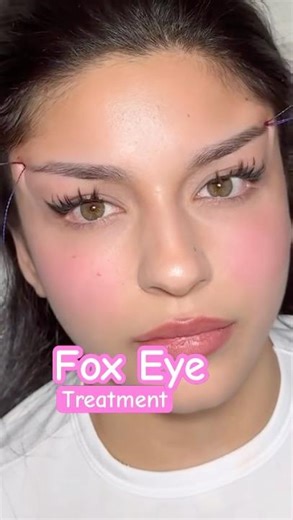 Fox Eye thread lift … #threadlift #foxeye
