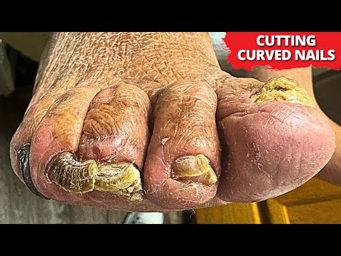 Cutting Extremely Thick, Curved Toenails | Oddly Satisfying Nail Care
