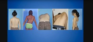 Spinal Alignment Issues: Scoliosis & More | Advanced Spine Center